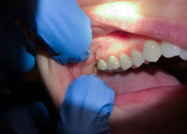 Best Emergency Dentist for Lost Fillings or Crowns in Skyline Acres, OH